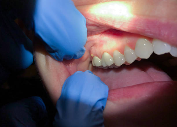 Best Emergency Wisdom Teeth Removal in Ashland, MO